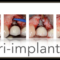 Peri-implantitis – 2-Day Surgical Course